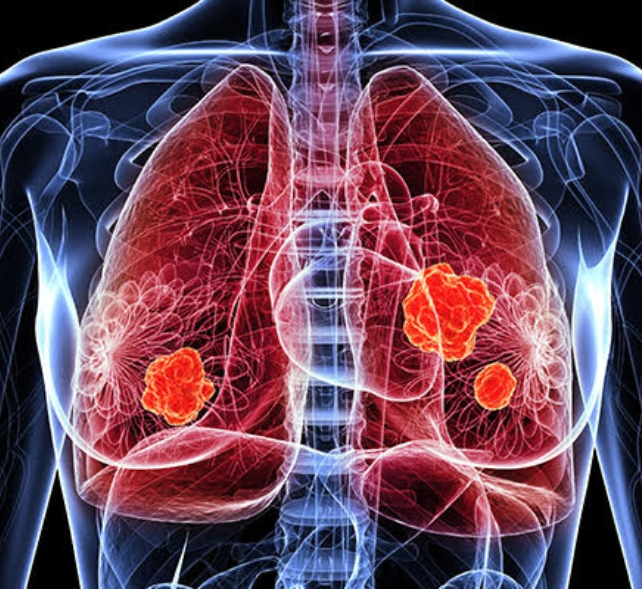 Comprehensive Solid Tumor Panel